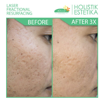 Acne Scar Laser