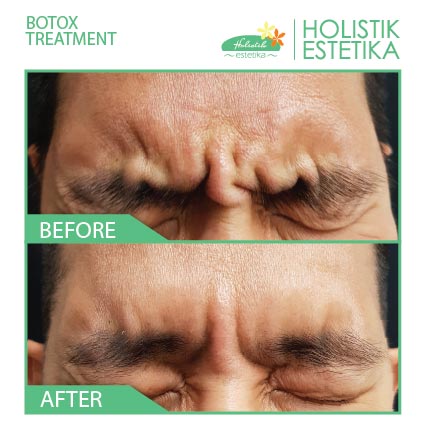 Botox Treatment