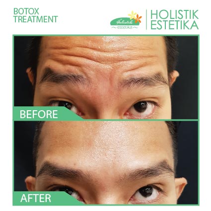Botox Treatment