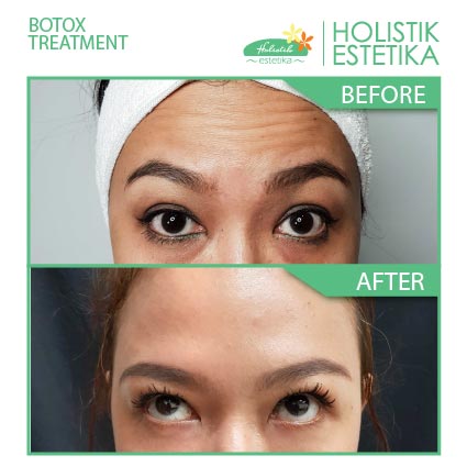 Botox Treatment